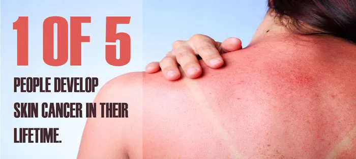 Graphic: 1 of 5 people develop skin cancer in their lifetime, with sunburned skin